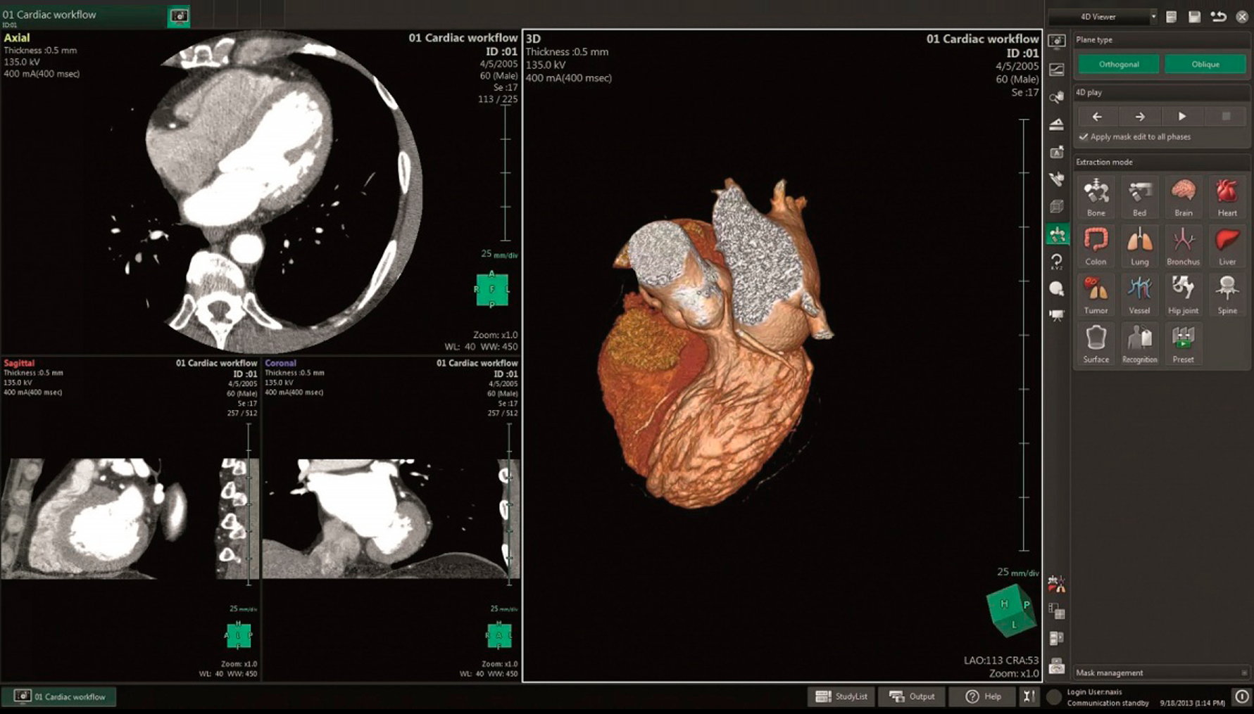 PACS synapse 3d